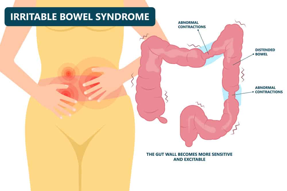 Natural IBS Relief: A Holistic Approach