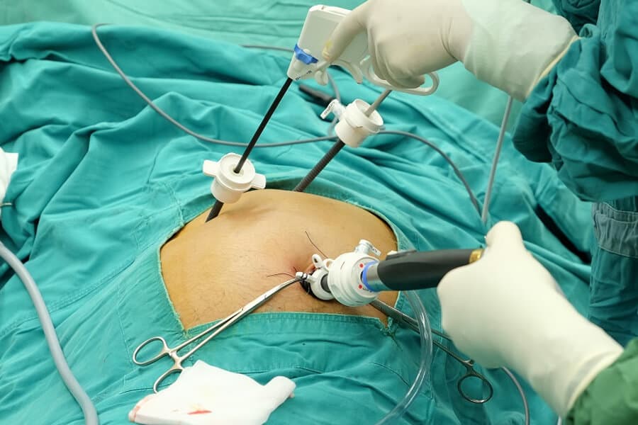 Gallbladder Surgery