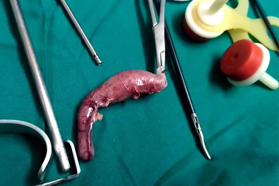 Appendectomy